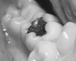 Question : remplacement d'amalgames dentaires