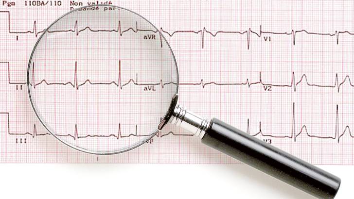 L'electrocardiogramme