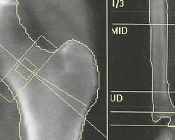 Ostéodensitométrie du col du fémur