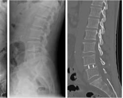 Radiographie du rachis lombaire