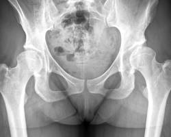 Comment lire une radiographie de la hanche
