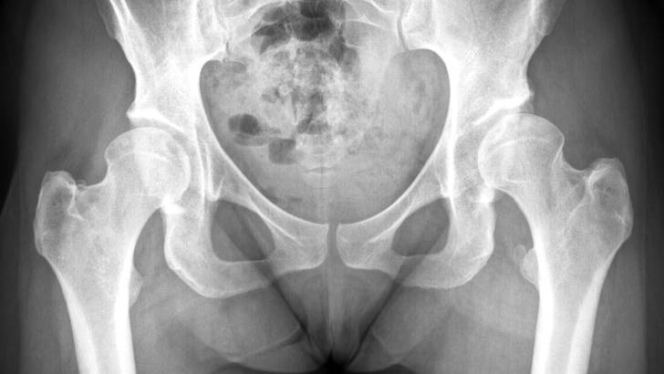 Comment lire une radiographie de la hanche