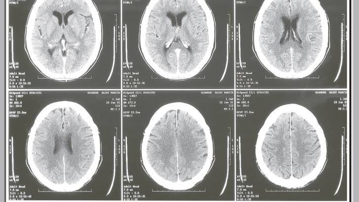 Le scanner cérébral, comme lire les examens