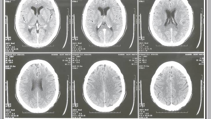 Comprendre les résultats de votre scanner cérébral - Soignez-vous