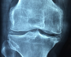 Témoignage : Adieu arthrose des genoux, lombaires, cervicales...