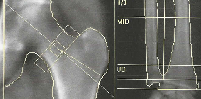 Ostéodensitométrie du col du fémur