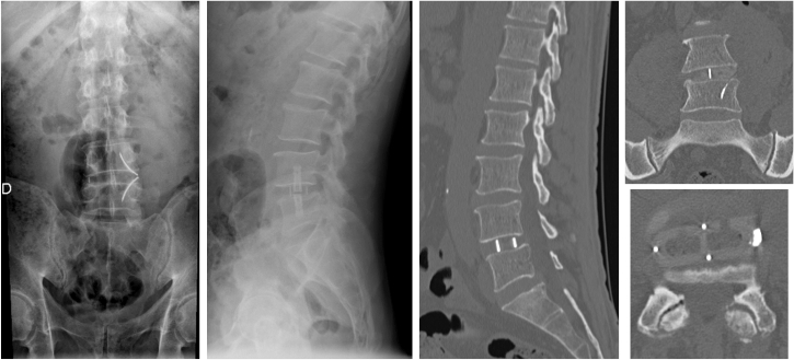 Radiographie du rachis lombaire